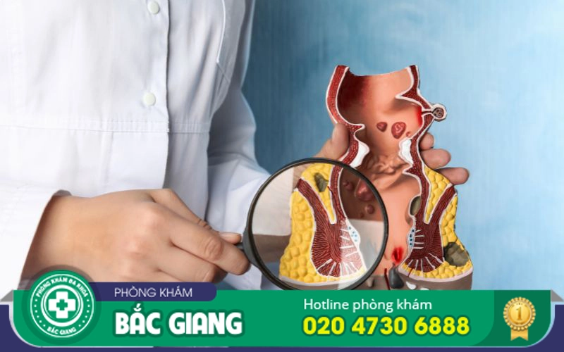 điều trị nứt kẽ hậu môn