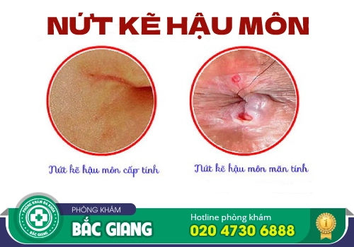 Một số hình ảnh nứt kẽ hậu môn mà bạn cần biết